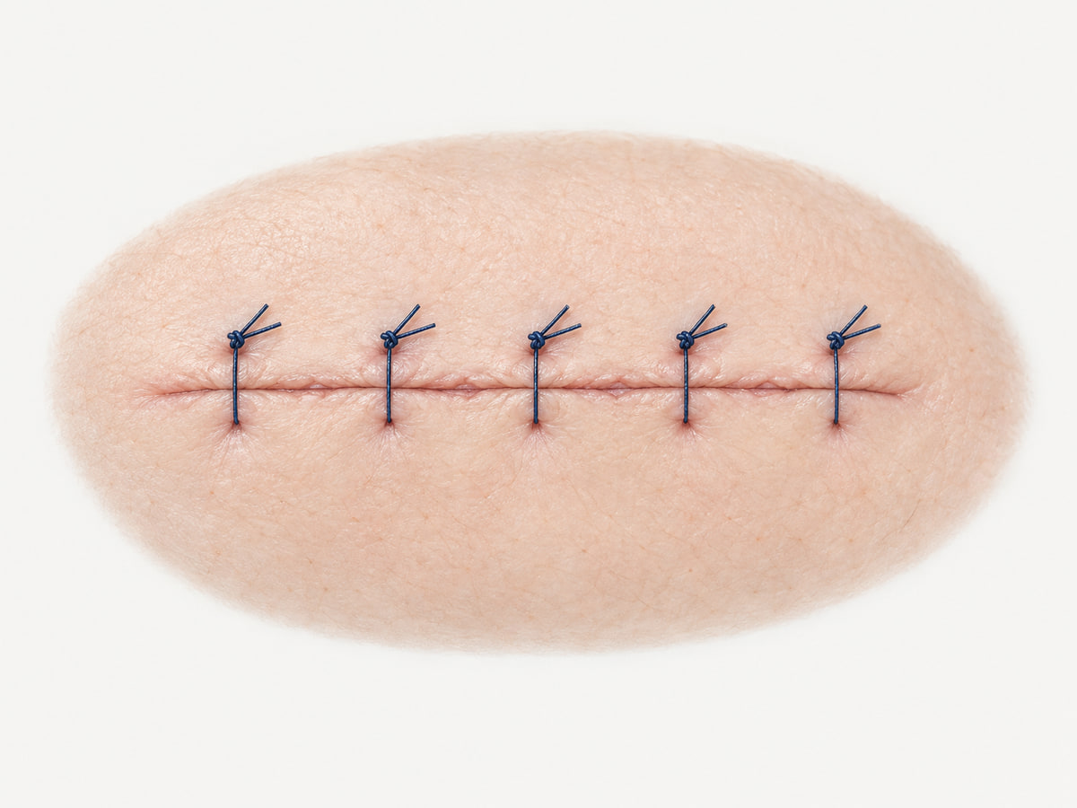 Illustration of a skin incision closed with separate interrupted sutures and knots beside the wound.